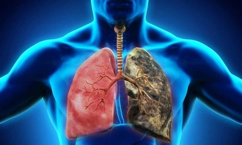 Respiratory Diseases