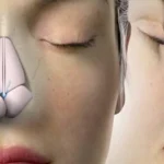 Rhinoplasty Surgery