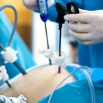 Liposuction Surgery