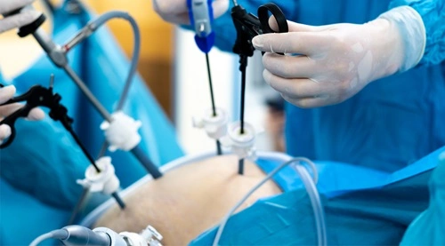 Liposuction Surgery