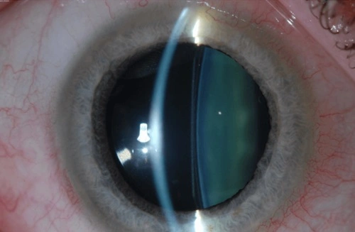 ICL Surgery