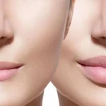 Lip Reduction Surgery