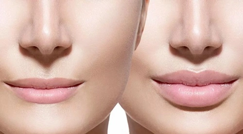 Lip Reduction Surgery