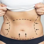 Liposuction Surgery