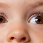 Child Cataract Surgery