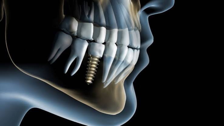 Implantology